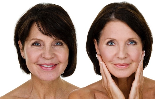 facial skin peel treatment kent