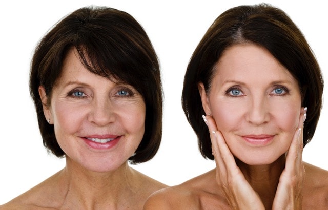 facial skin peel treatment kent