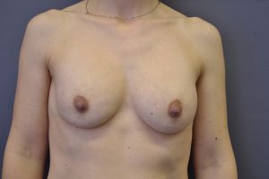 Secondary Breast Augmentation Kent
