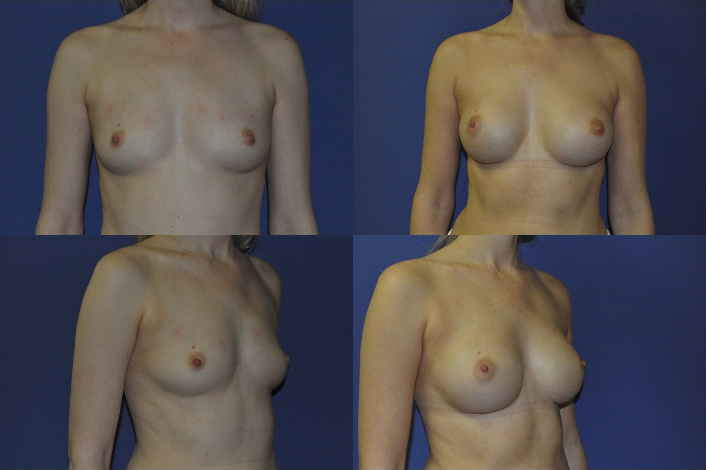 breast enlargement surgery kent