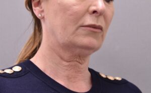 Patient 2 pre Neck Lift