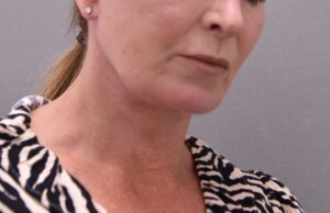 Patient 2 post Neck Lift