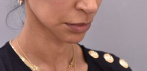 Patient 1 post Neck Lift
