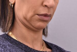 Patient 1 pre Neck Lift