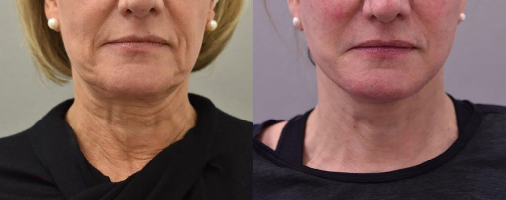 Deep Neck lift results