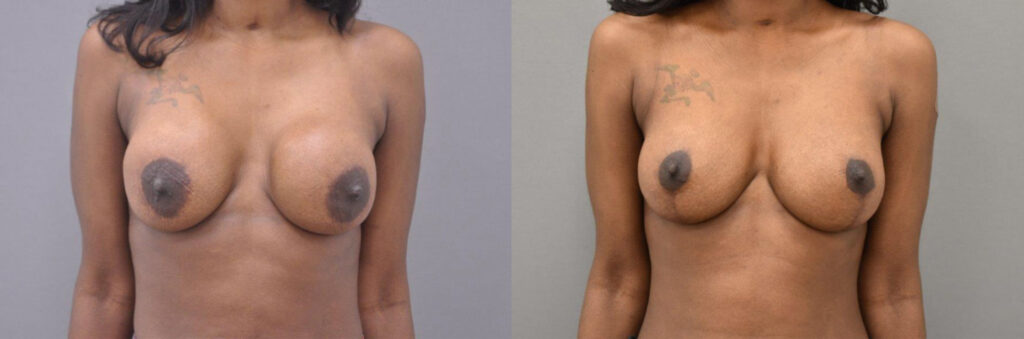 Capsular Contracture Treatment Before & After 