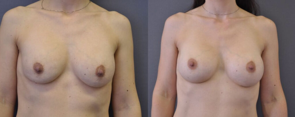 Capsular Contracture Treatment Before & After