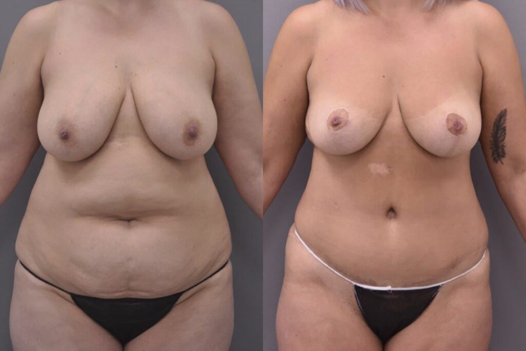 Before & After Photo Mummy Makeover Tunbridge Wells Kent