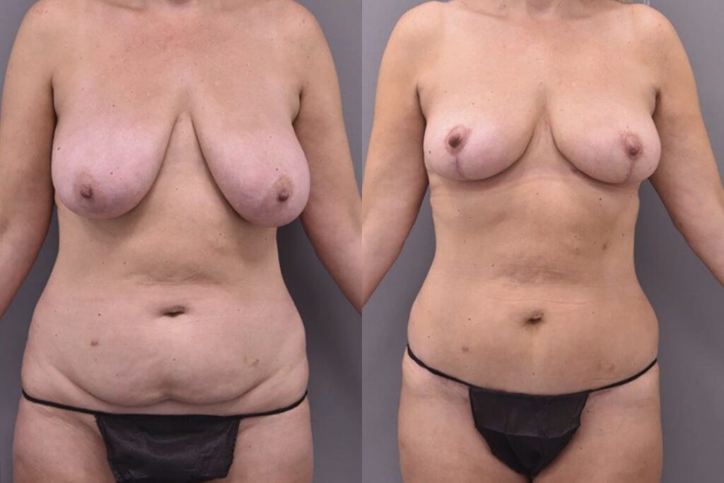 Before & After Photo Mummy Makeover Tunbridge Wells Kent