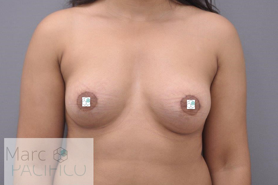 Case--7857 | After Tuberous Breast Surgery