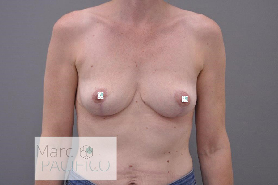 Case--4634 | After Breast Implant Removal