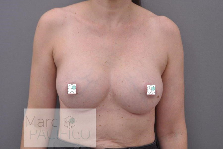 Case--5905 | After Breast Augmentation
