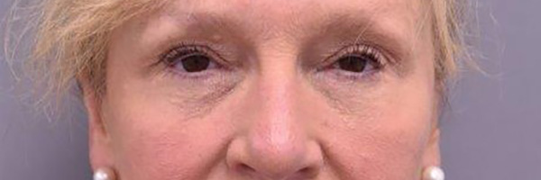 Case--7905 | After Eyelid Surgery