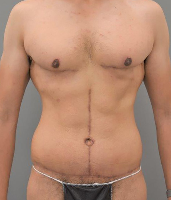 Case--2020 | After Post Weight Loss Surgery