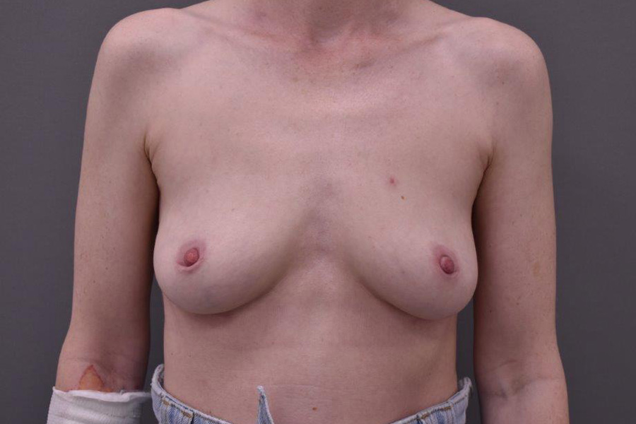 Case--2129 | After Breast Implant Removal