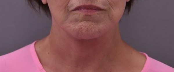 Case--6346 | After Facelift and Neck Lift