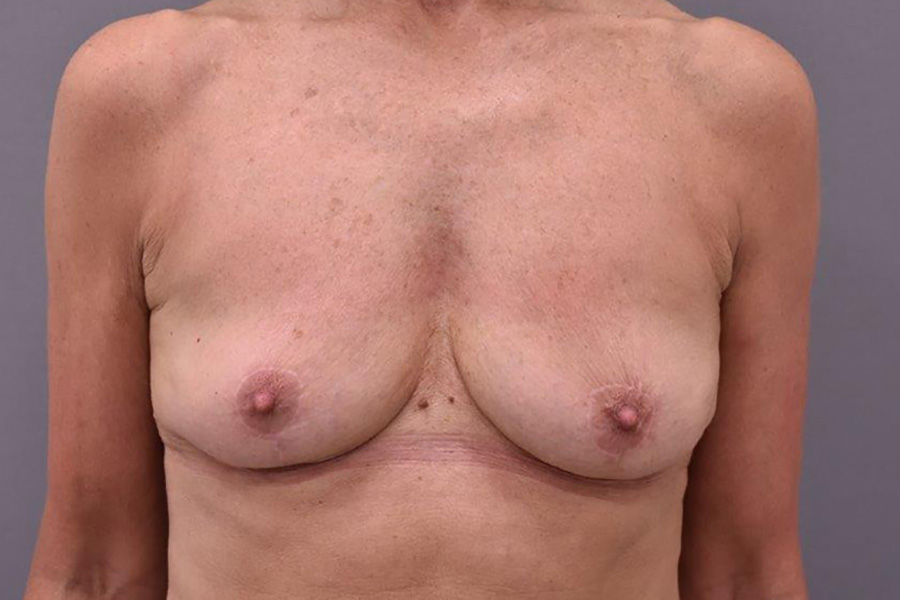 Case--6441 | After Breast Implant Removal