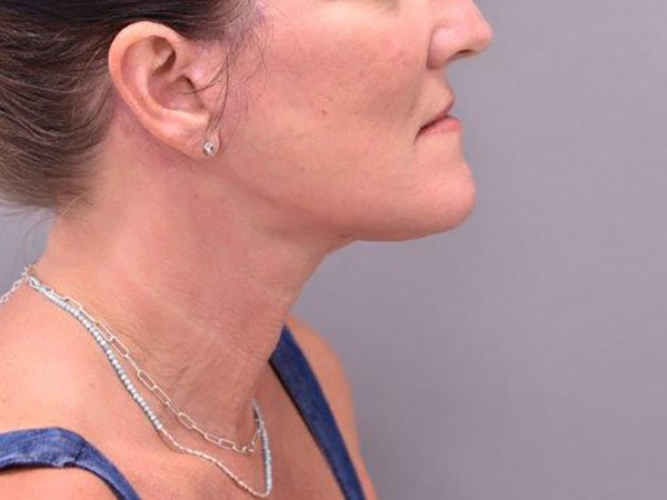 Case--2517 | After Facelift and Neck Lift