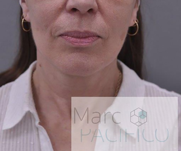 Case--4567 | After Facelift and Neck Lift