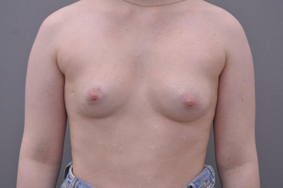 Case--1636 | After Tuberous Breast Surgery
