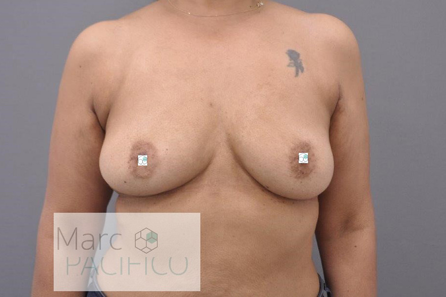 Case--2848 | After Breast Implant Removal