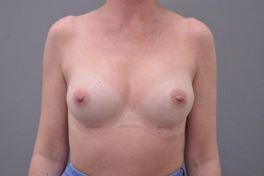 Case--2514 | After Breast Augmentation