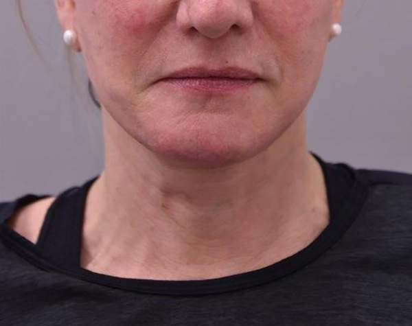 Case--9111 | After Facelift and Neck Lift