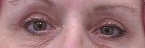 Case--8316 | After Eyelid Surgery