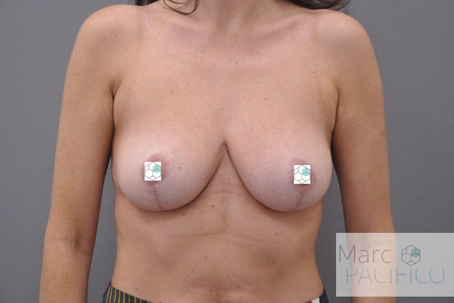 Case--7479 | After Breast Reduction