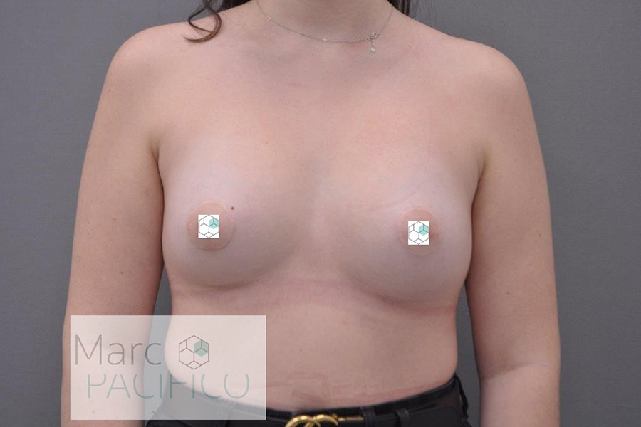 Case--1550 | After Tuberous Breast Surgery