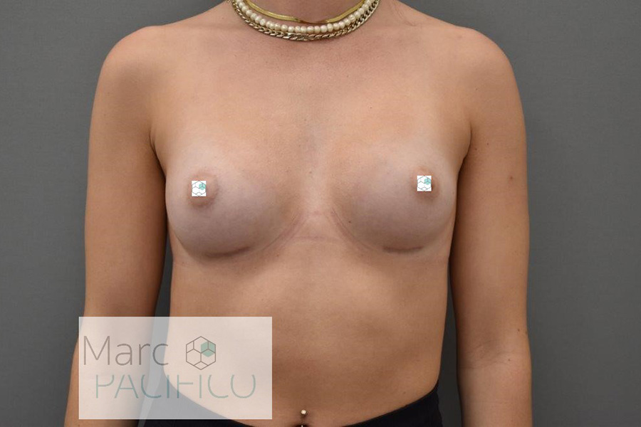 Case--9099 | After Breast Augmentation