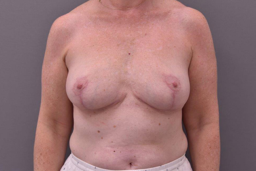 Case--7574 | After Breast Implant Removal