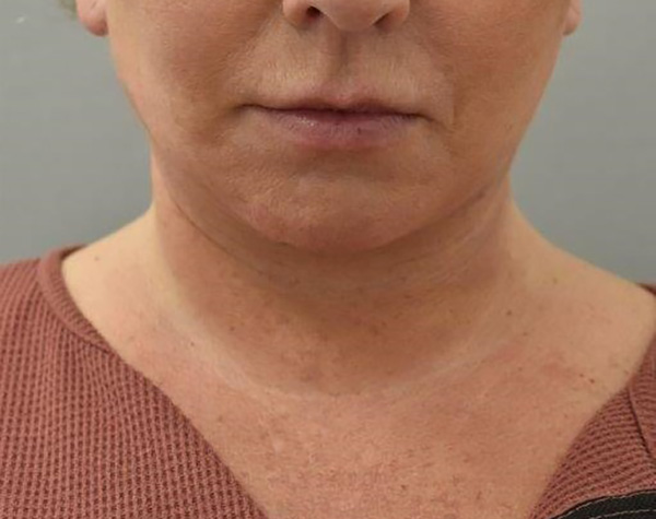 Case--6052 | After Facelift and Neck Lift