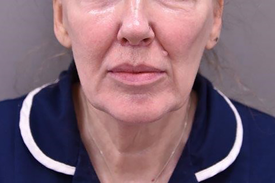 Case--9780 | After Lip Lift