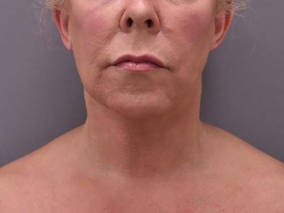 Case--5123 | After Facelift and Neck Lift