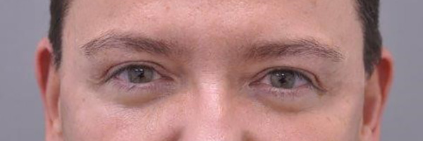 Case--9083 | After Eyelid Surgery