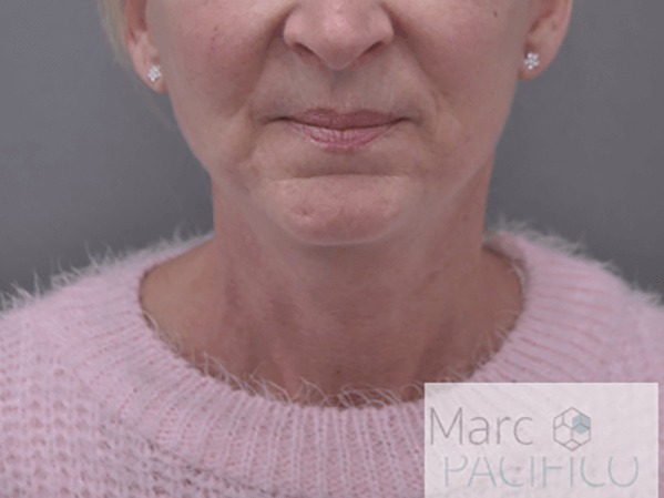 Case--4518 | After Facelift and Neck Lift