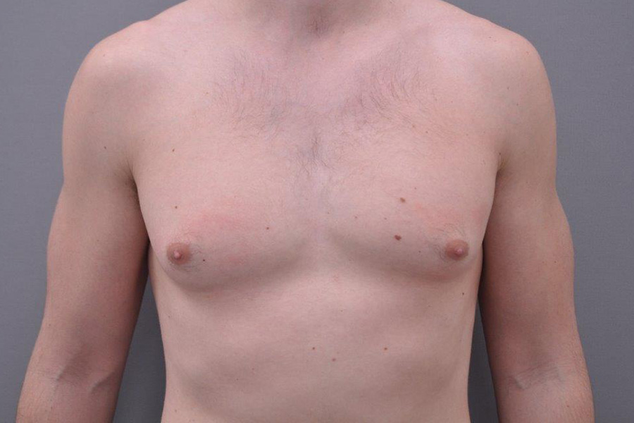 Case--7950 | Before Gynecomastia Correction