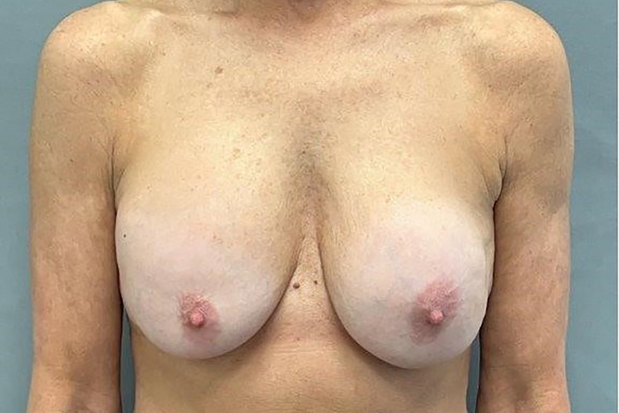 Case--6441 | Before Breast Implant Removal
