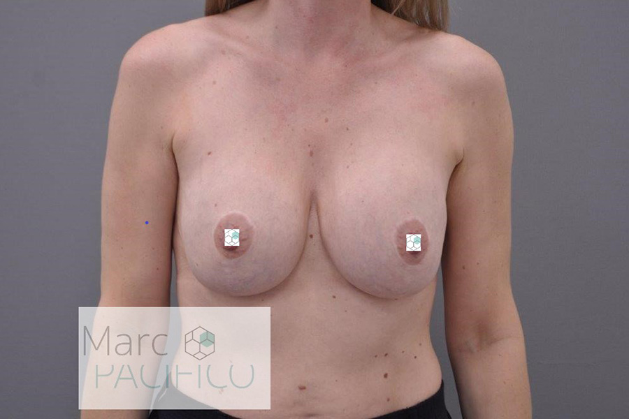 Case--4634 | Before Breast Implant Removal