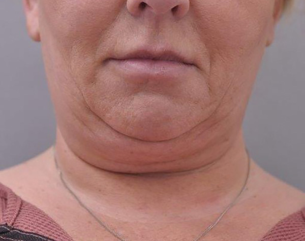 Case--6052 | Before Facelift and Neck Lift