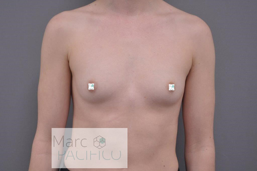 Case--9099 | Before Breast Augmentation