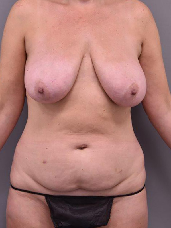 Case--5198 | Before Mommy Makeover