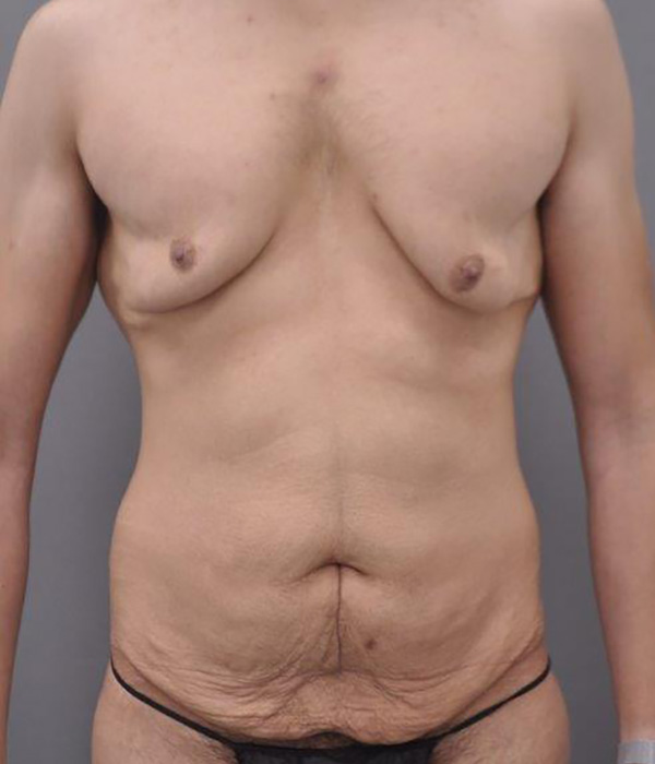 Case--2020 | Before Post Weight Loss Surgery