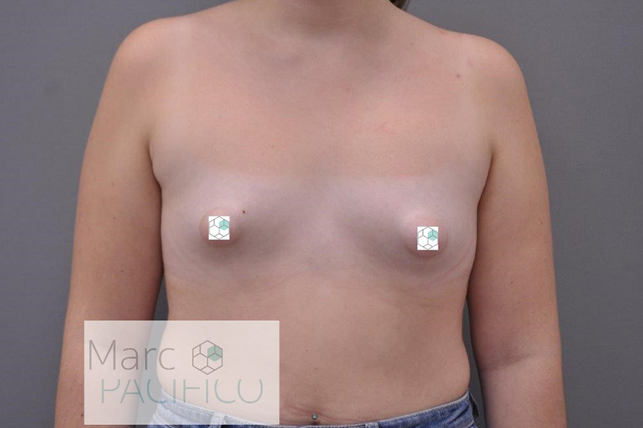 Case--1550 | Before Tuberous Breast Surgery
