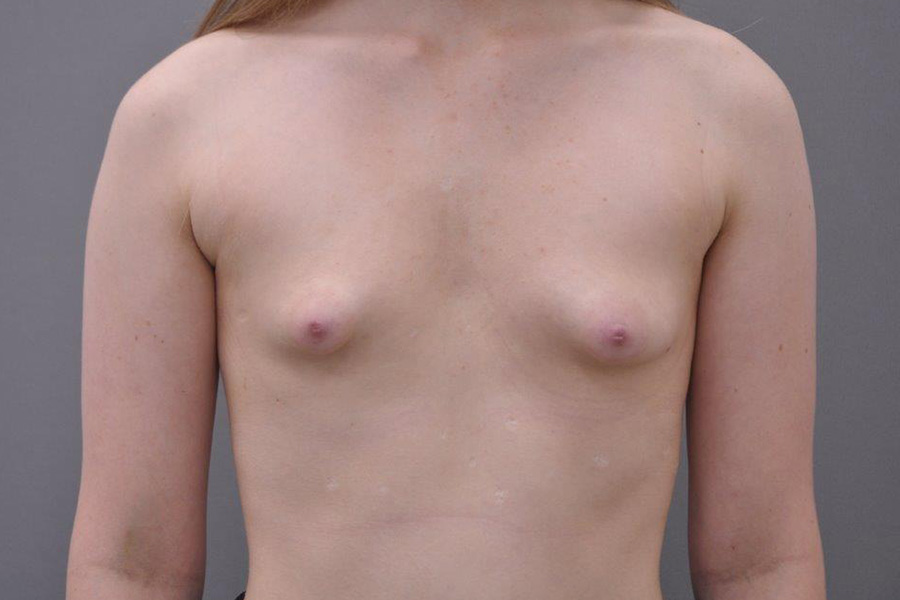 Case--1636 | Before Tuberous Breast Surgery