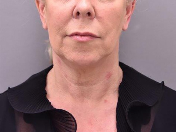 Case--5123 | Before Facelift and Neck Lift