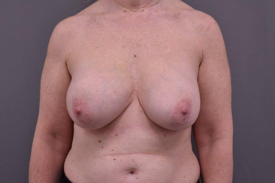 Case--7574 | Before Breast Implant Removal