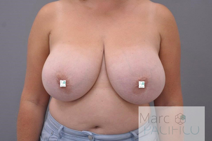 Case--7184 | Before Breast Reduction