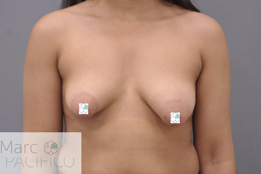 Case--7857 | Before Tuberous Breast Surgery